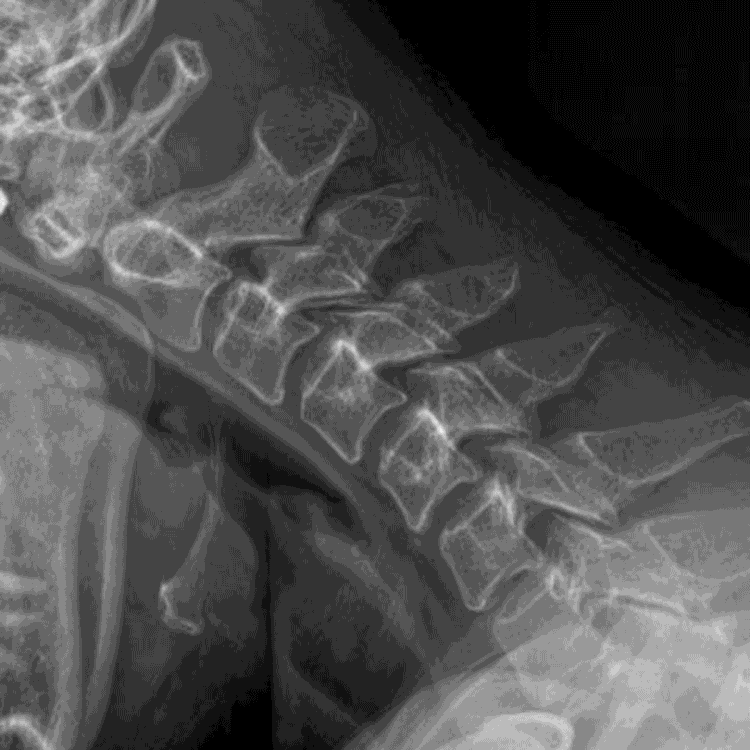 cervical-motion Animated cervical spine motion X-ray showing vertebral alignment and AOMSI analysis lines from C2 to C7.